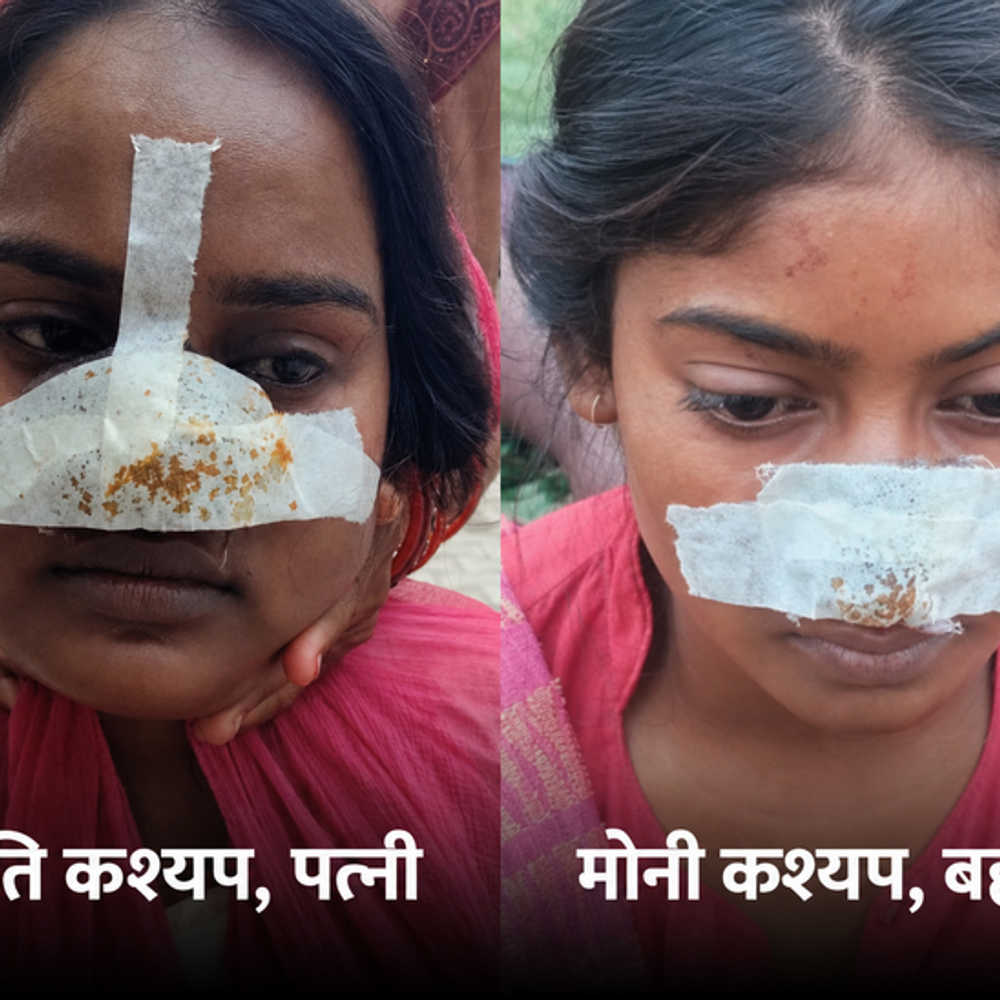 लखीमपुर में पति ने दांतों से पत्नी की नाक काटी:मायके जाने पर अड़ी थी, मां ने ननद की नाक काटकर बदला लिया